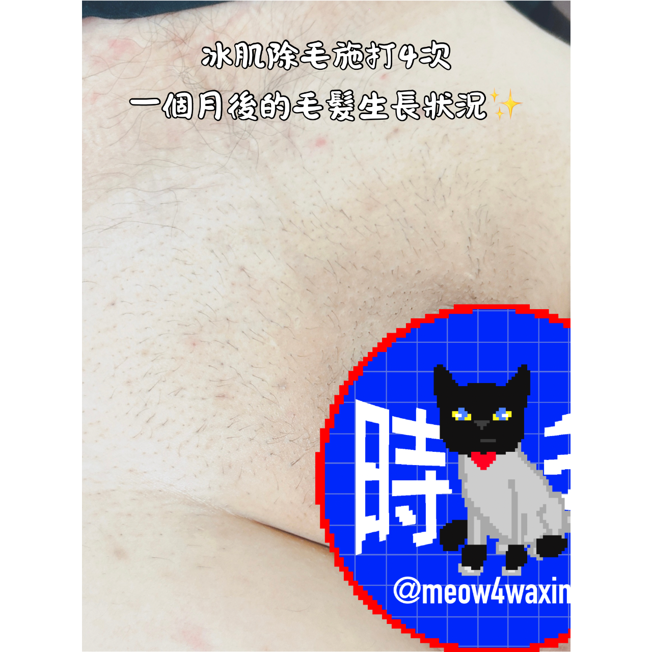 時毛·台中男性熱蠟/冰肌無痛除毛/抓龍筋 台中男性除毛