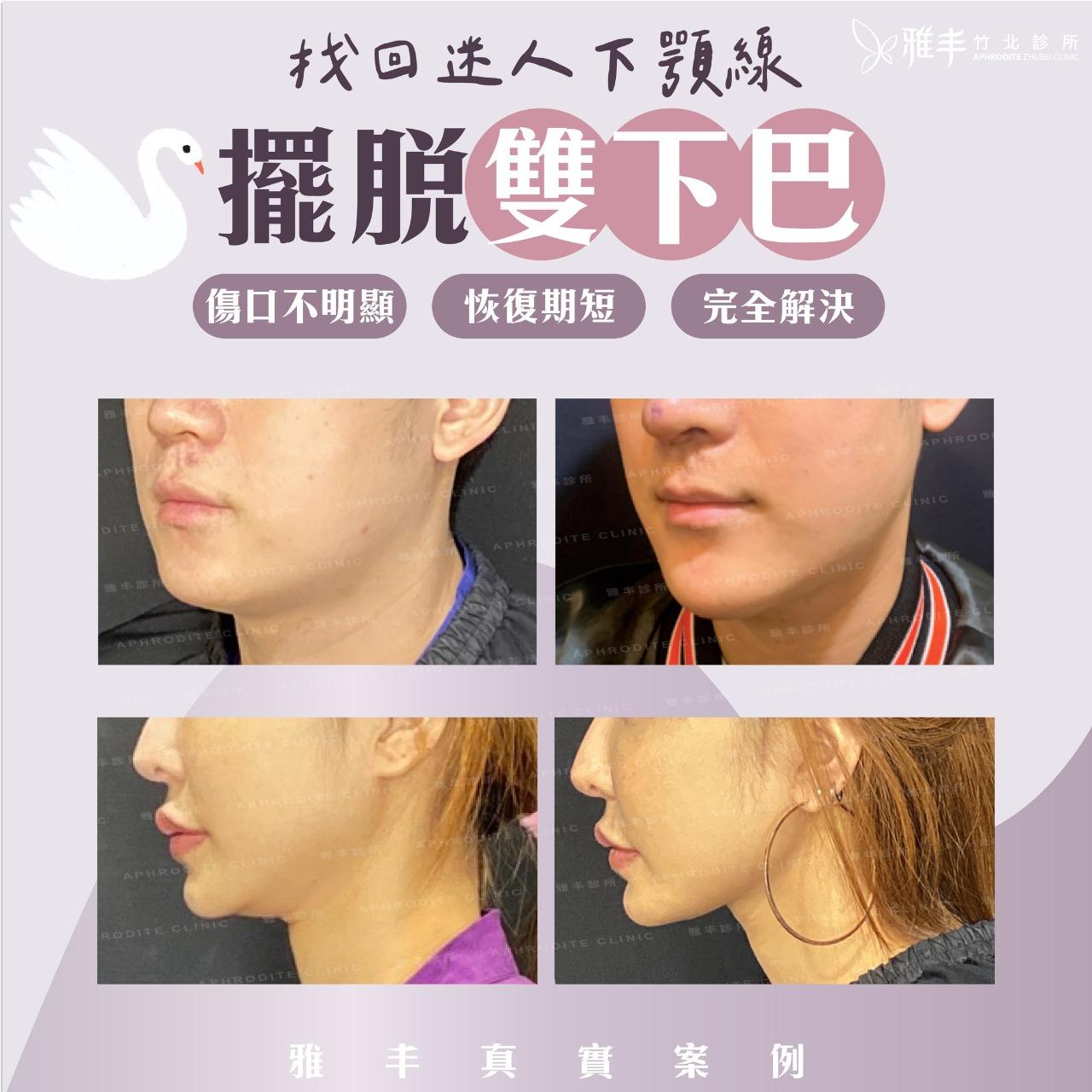 🔔 叮咚醫師 🔔 整型外科 陳建鼎醫師 天鵝頸 雙下巴 抽脂
