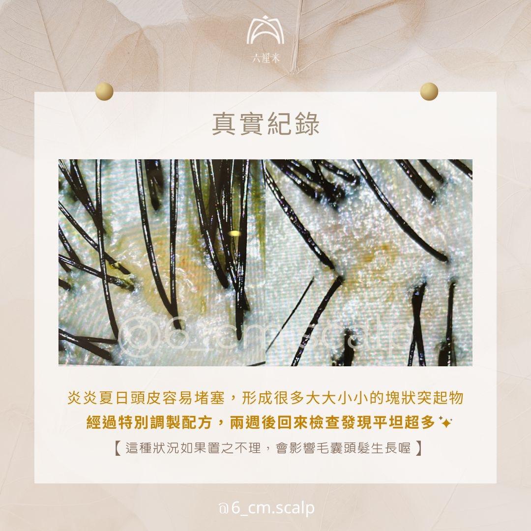 六厘米 本案例為客戶真實分享，實際成效因頭皮狀況等因素有所差異