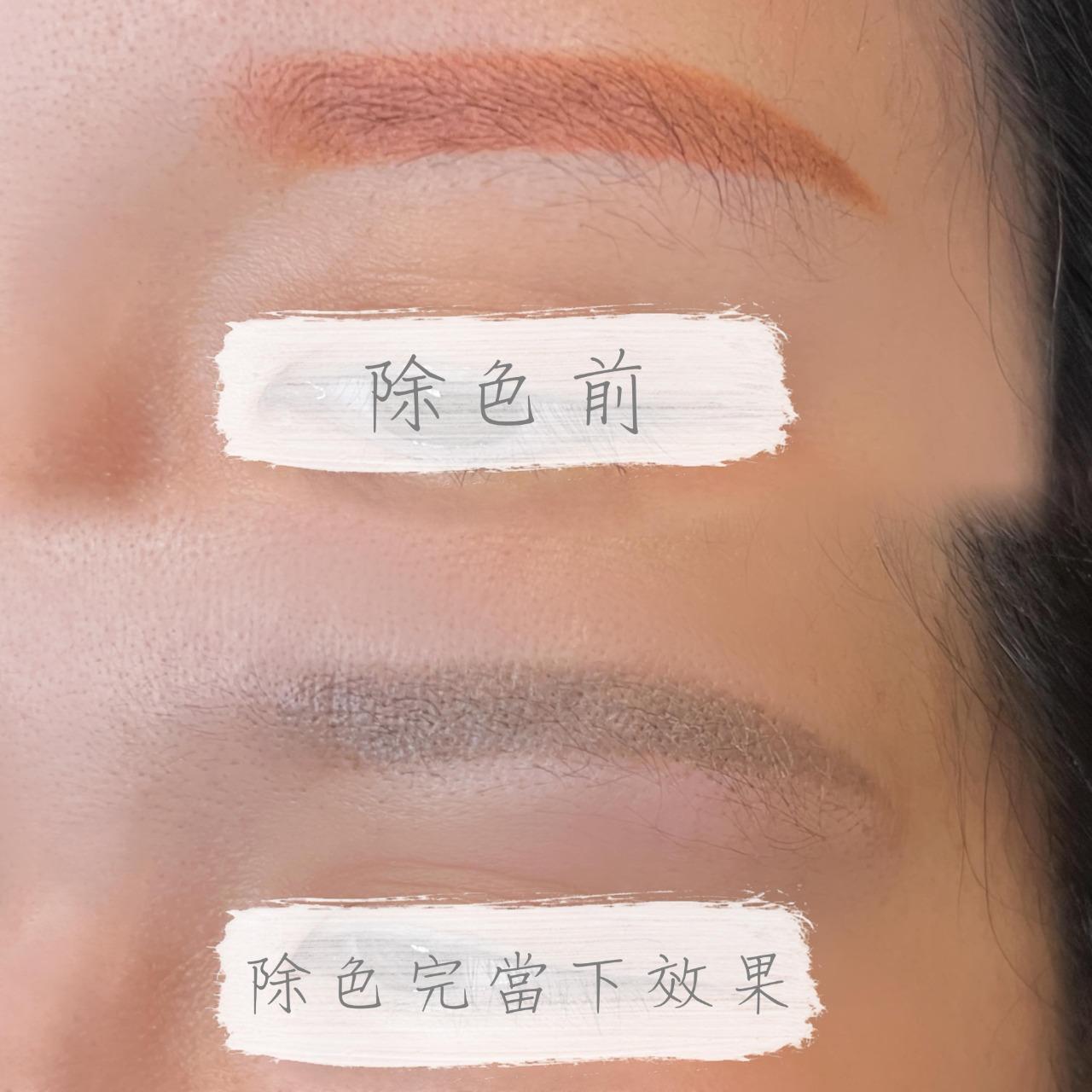 面部美化專家—曼曼 無創除色