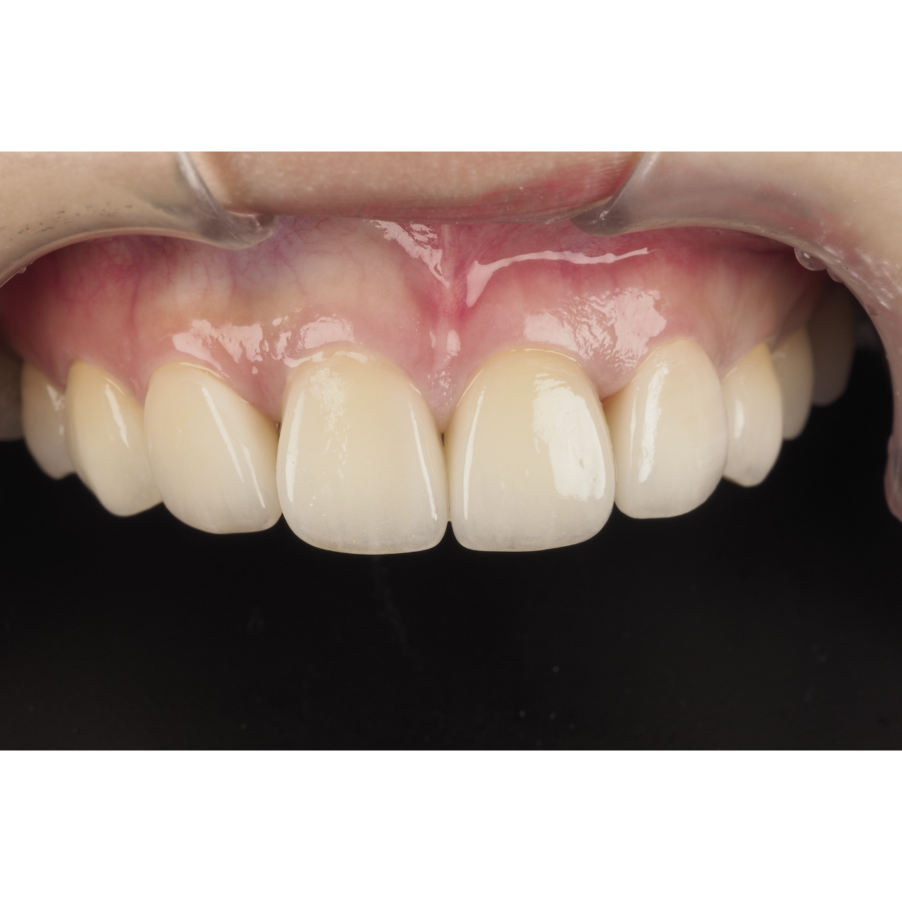 黃建勳 牙醫師 術後