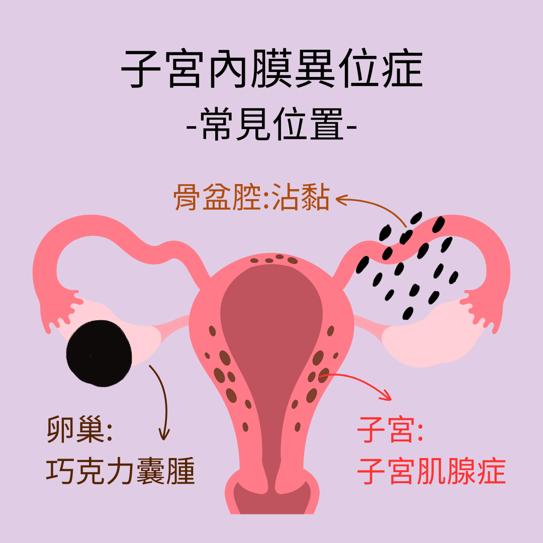 子宮內膜異位症