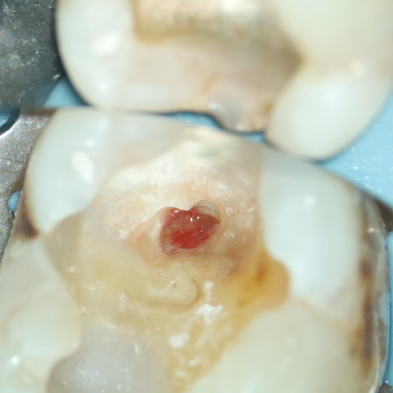 黃建勳 牙醫師 牙髓暴露