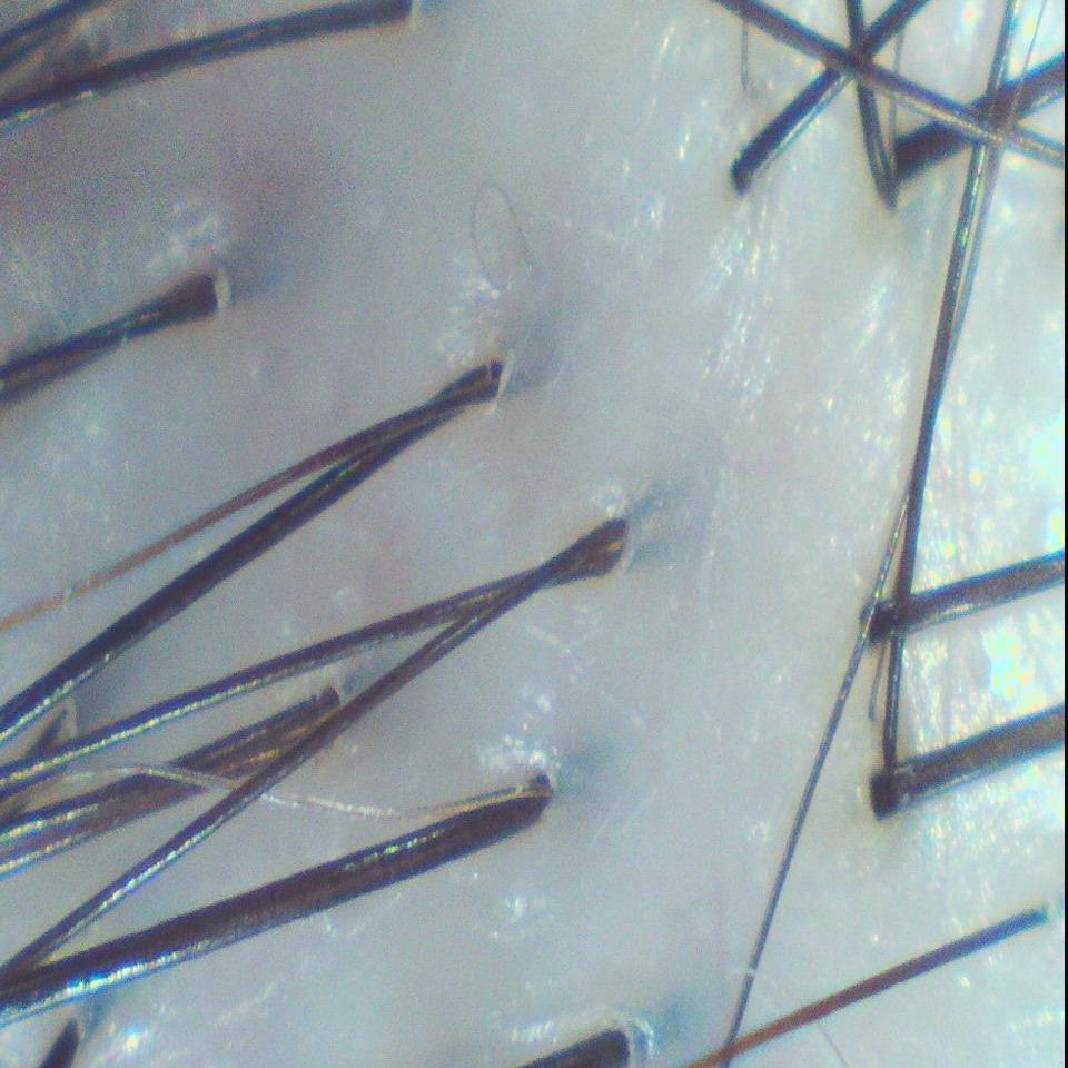 森挪威頭皮養護旗艦店 油性皮屑  After