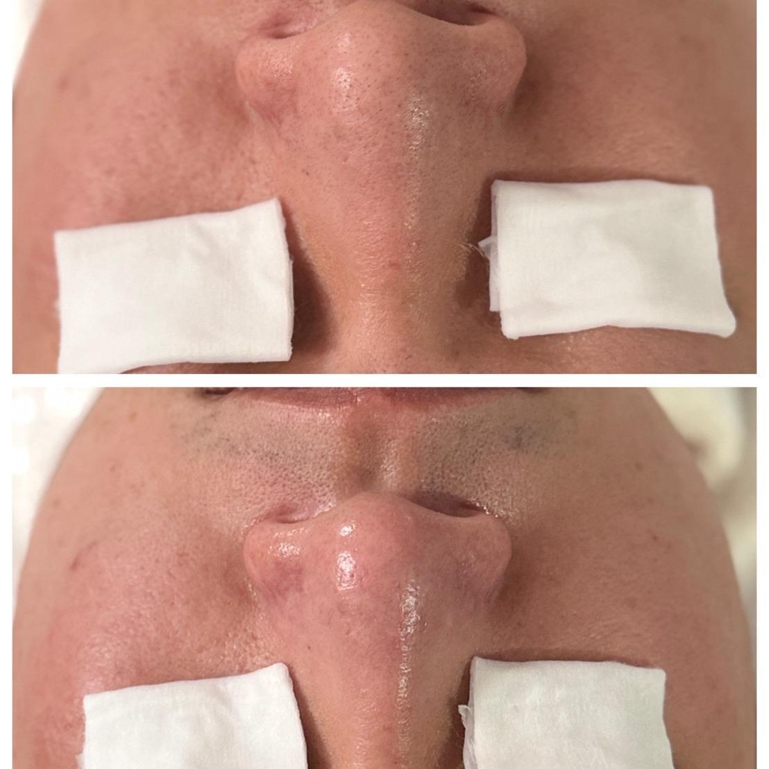 CHIAO EAR瞧耳｜台北採耳｜皮膚管理｜採耳耳燭｜淨化臍燭｜低痛感清粉刺 皮膚管理 清粉刺 做臉 台北