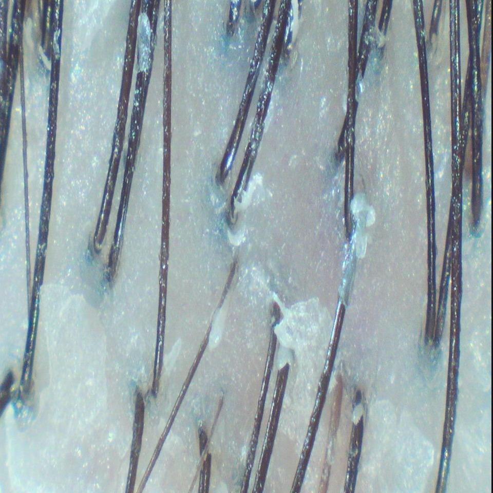 森挪威頭皮養護旗艦店 油性皮屑  Before