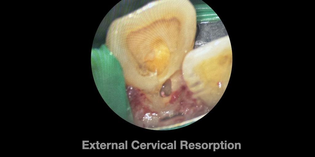 張益彰醫師 | 衛福部定牙髓病專科 根尖手術