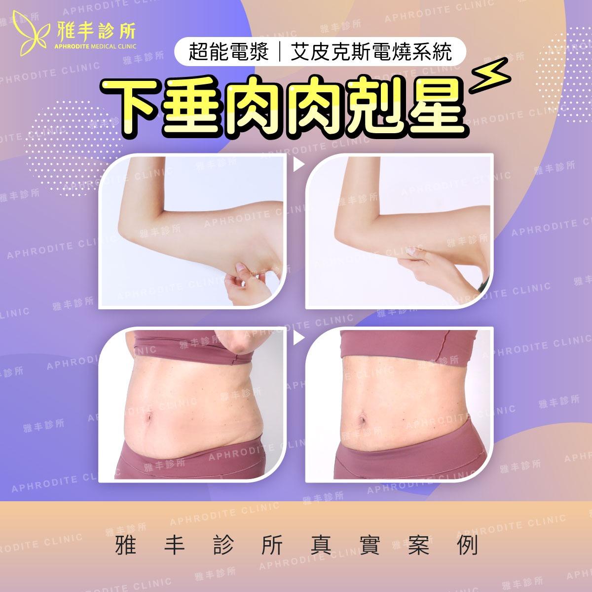 🔔 叮咚醫師 🔔 整型外科 陳建鼎醫師 🔔抽脂