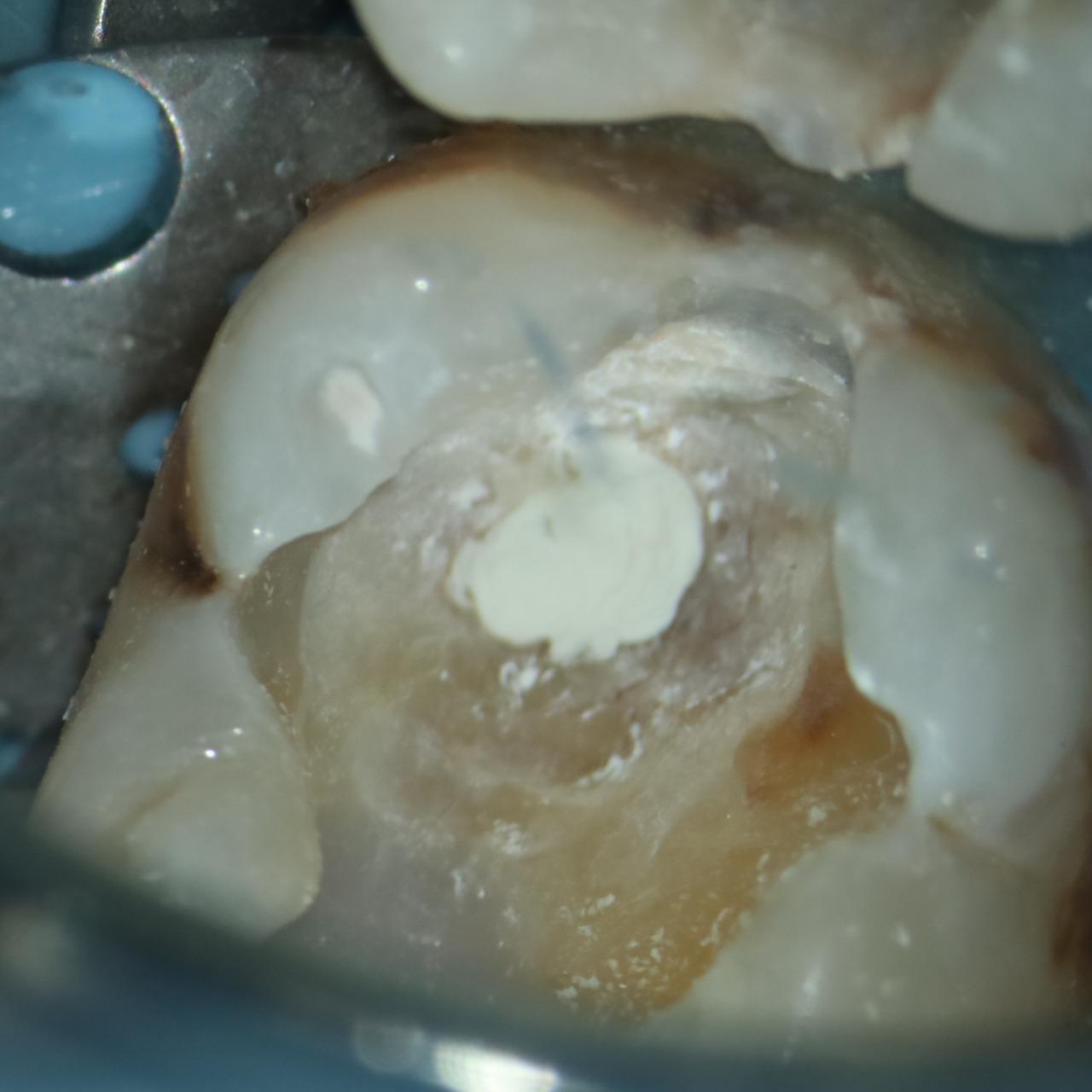 黃建勳 牙醫師 覆蓋生物陶瓷材料