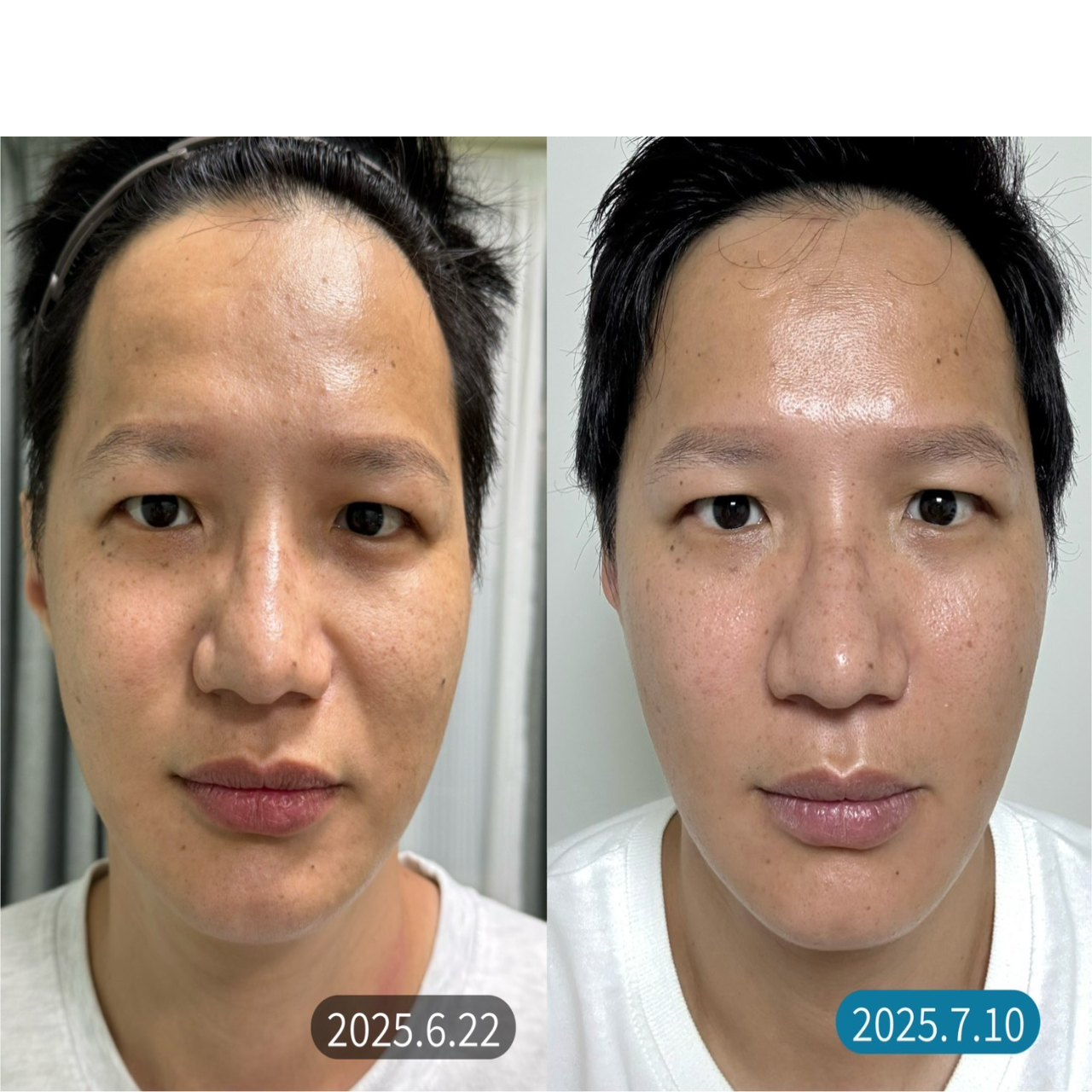 珊姐-浪肌天涯 黑科技無傾入外泌體升級青春