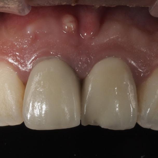 黃建勳 牙醫師 牙根斷裂