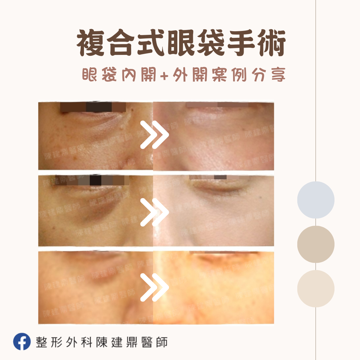 🔔 叮咚醫師 🔔 整型外科 陳建鼎醫師 眼袋 割眼袋 眼袋手術