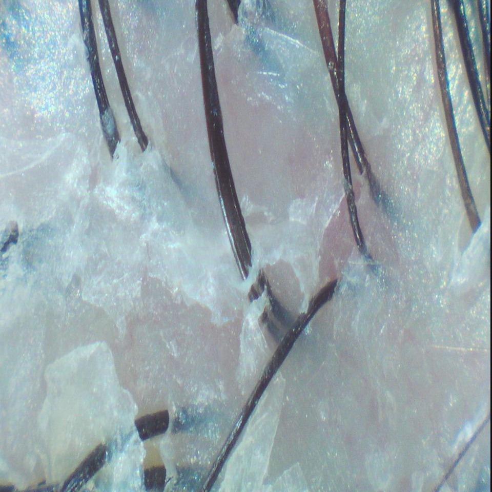 森挪威頭皮養護旗艦店 乾性皮屑  Before