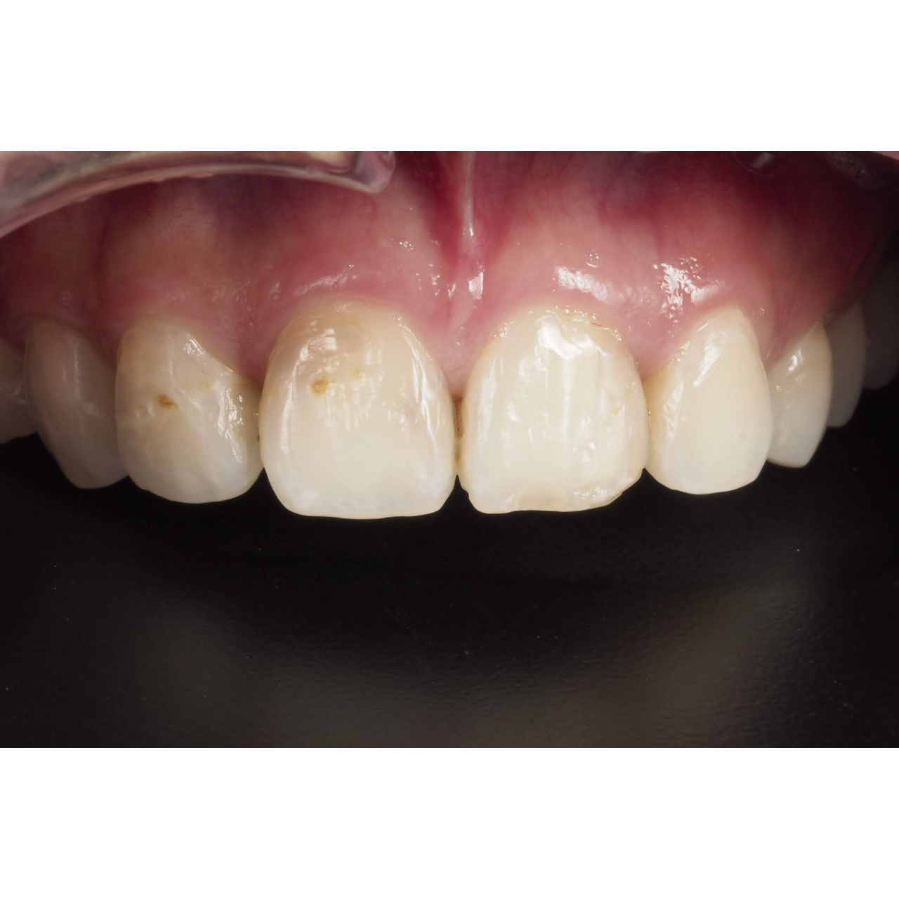 黃建勳 牙醫師 術前