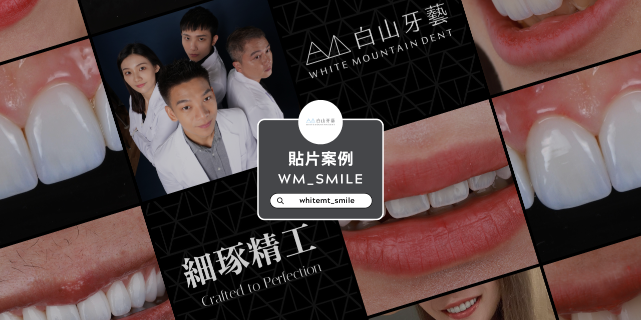 白山牙藝｜WHITE MOUNTAIN DENT 白山牙藝，一日美齒貼片案例